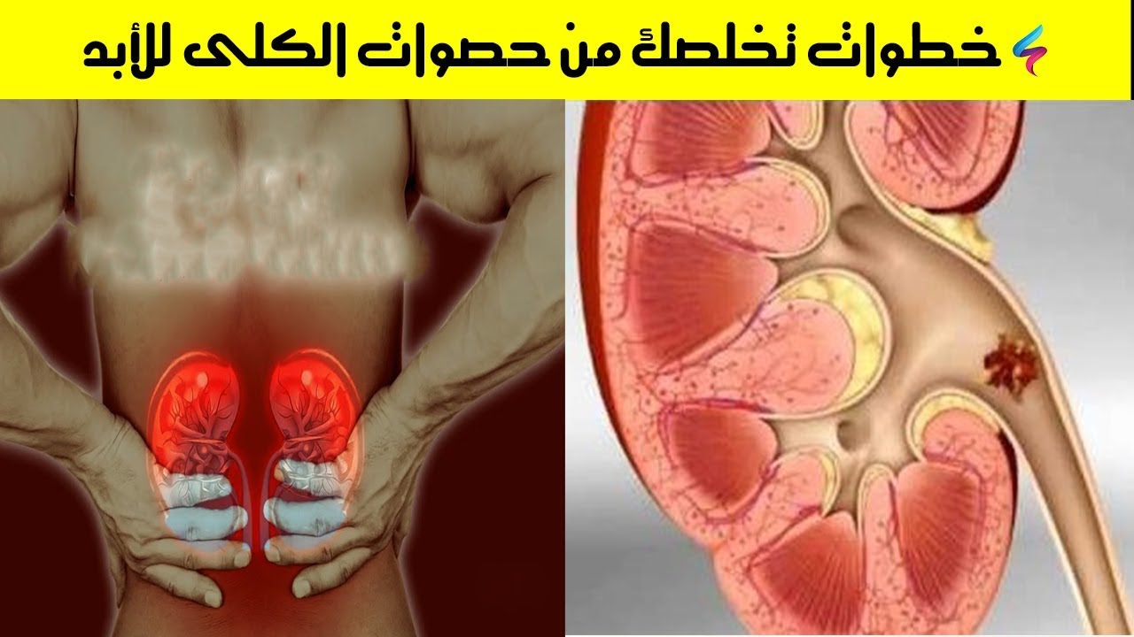 حصى الكلى وطرق علاجه الطبيعية - جنبي يوجعني كثيرا 2987