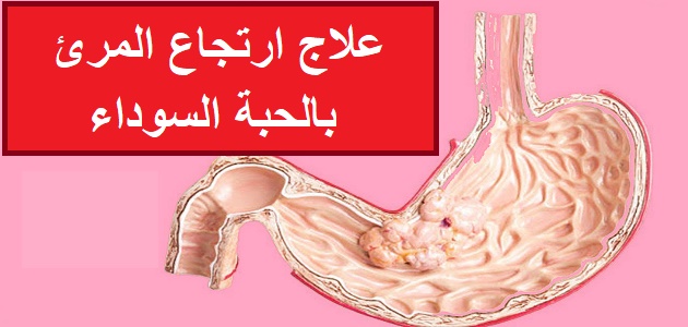 علاج ارتجاع المرئ بالحبة السوداء - اسباب الاصابه بارتجاع المرئ 3851