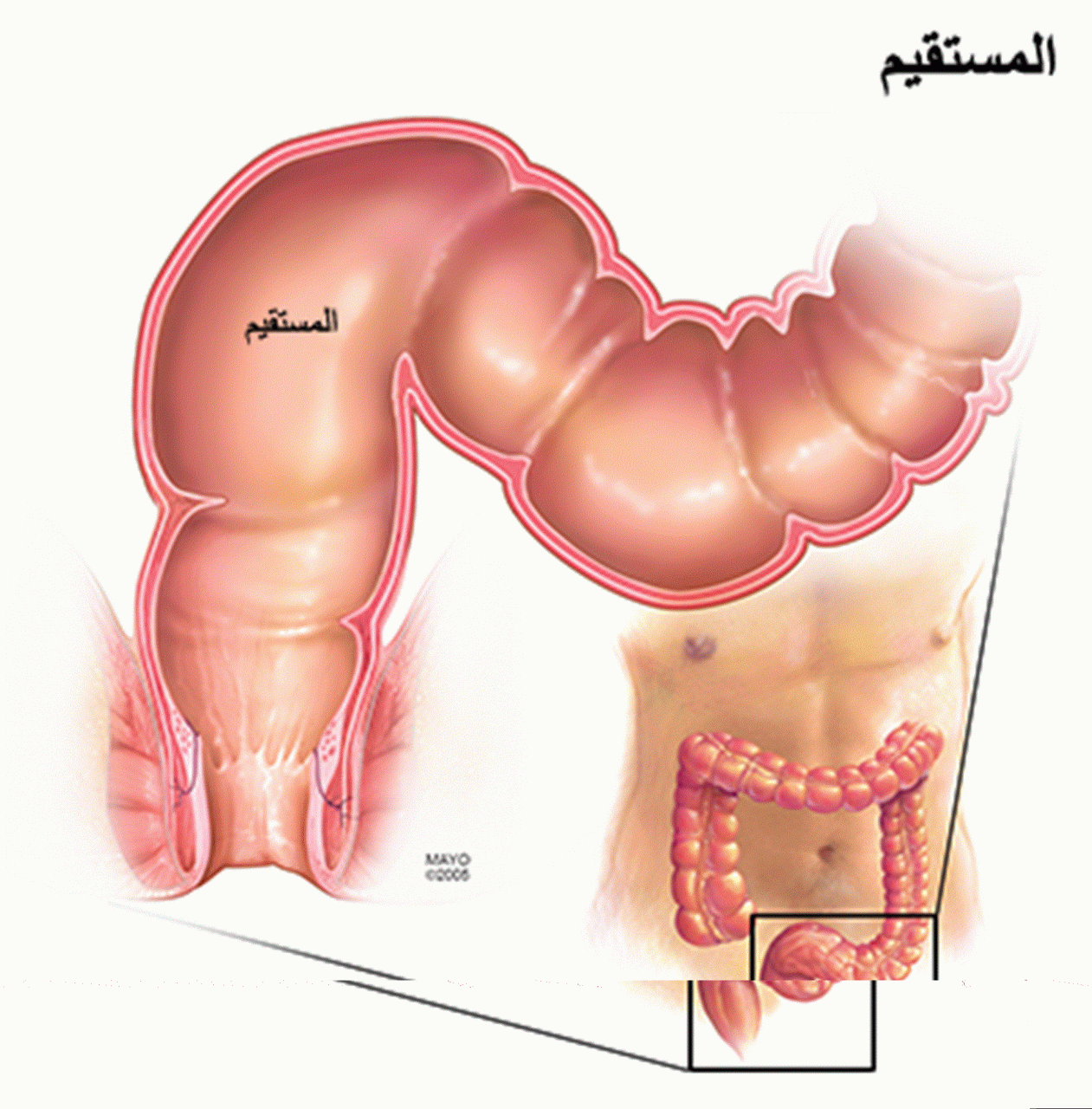 علاج التهاب المستقيم بالاعشاب , العلاج الفتاك لالتهاب المستقيم