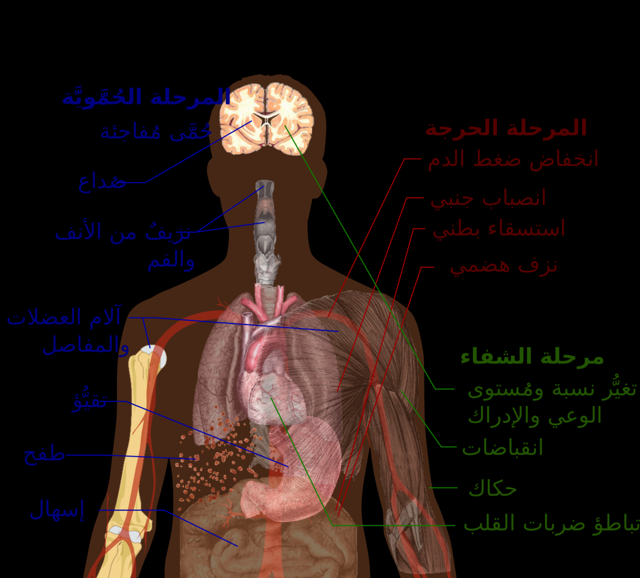 علاج حمى الضنك - احذر من لدغة الناموسة 2163