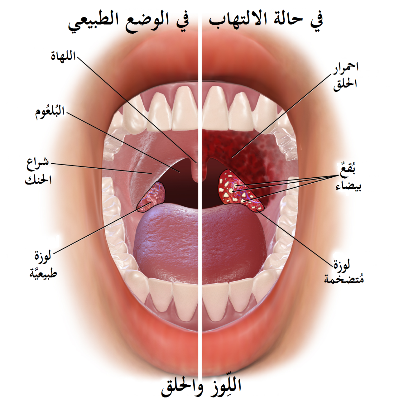 علاج طبيعي للوز , التخلص من التهاب اللوز