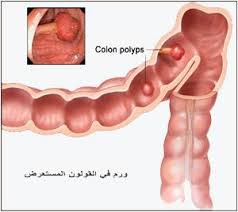 اسباب لون البراز اسود - نزول دم فى البراز 3147 2