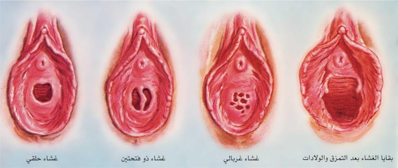 فض غشاء البكار