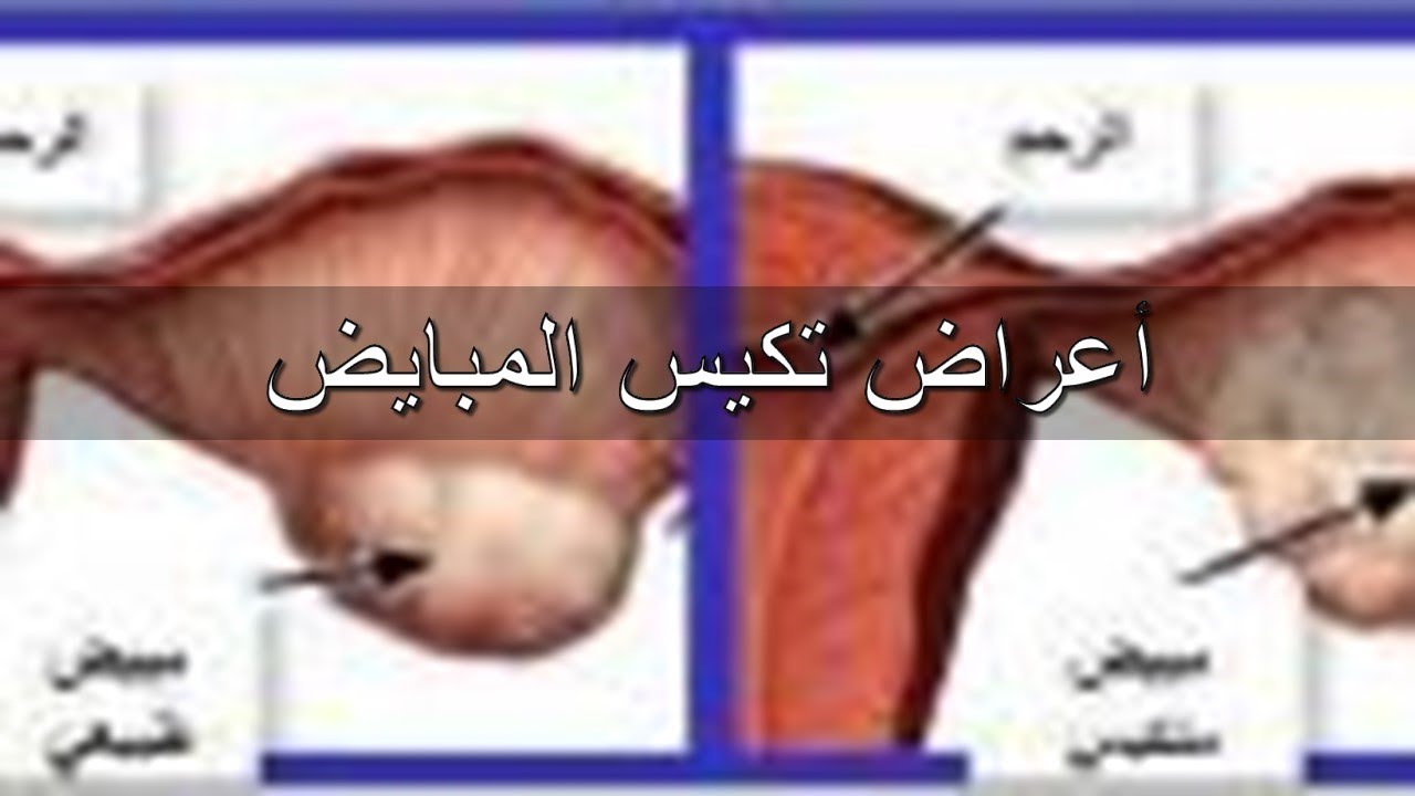 اعراض التكيس وقت الدوره - يجب الاهتمام بالصحه جيدا 2880 2