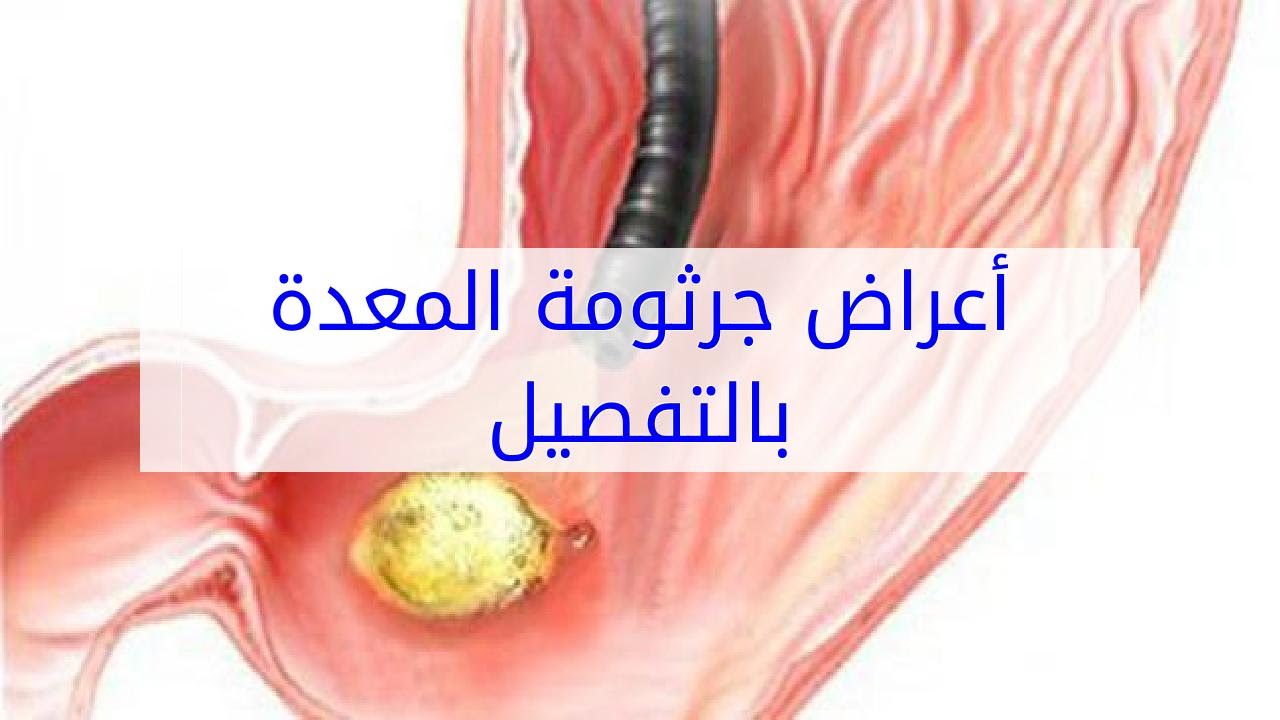 اعراض جرثومة المعدة , هي من اخطر الامراض