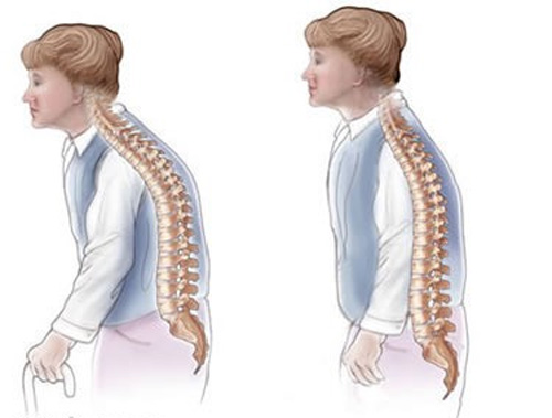 تعرف علي تشوه العمود الفقري ،اسباب اعوجاج العمود الفقري 131 2