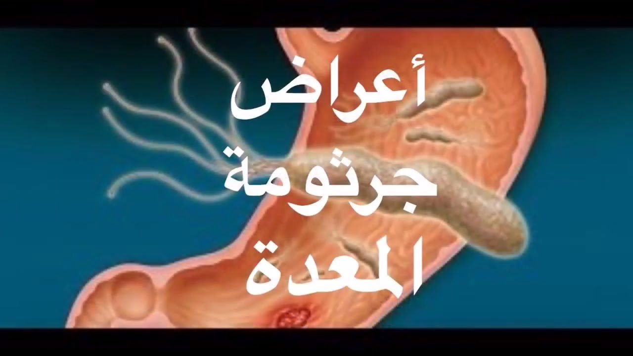 اعراض جرثومة المعدة - هي من اخطر الامراض 2690 1