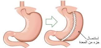 عملية تكميم المعدة - عمليات تخسيس البطن 3091 1