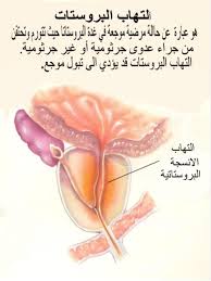 سرطان البروستاتا والعادة السرية , العادة السريه تسبب مرض