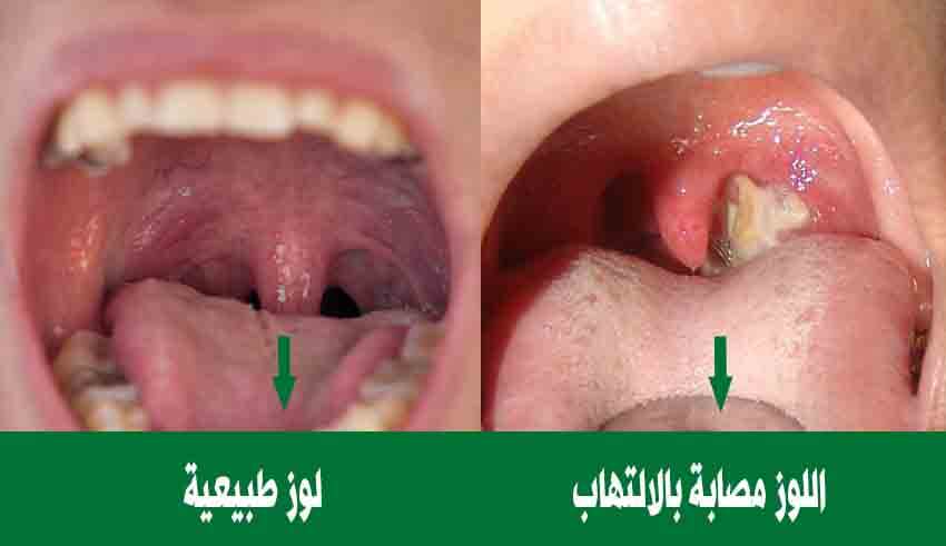 التخلص من التهاب اللوزتين - تخلص من التهاب الحلق من الان 450 2