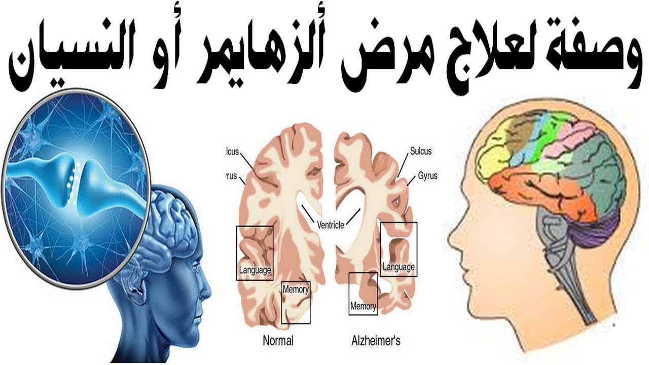 علاج مرض النسيان , انسى بسرعه جدا