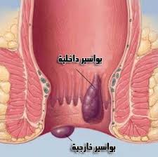 ما اعراض البواسير - ايه هو مرض البواسير 3320 3