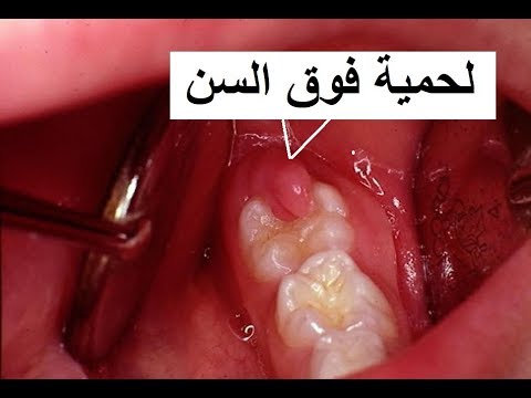 لحمية فوق ضرس العقل , طرق علاج مشاكل ضرس العقل