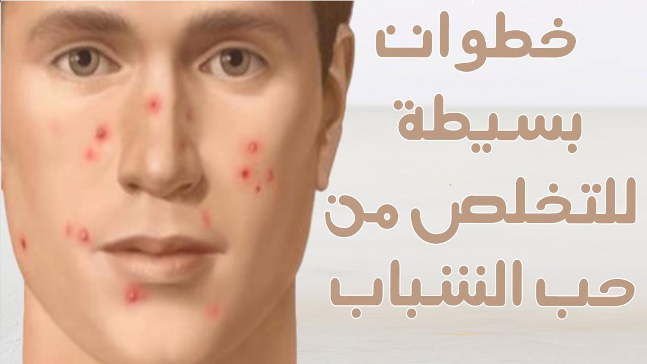 خلطات للتخلص من الحبوب , احسن علاج لحبوب الشباب