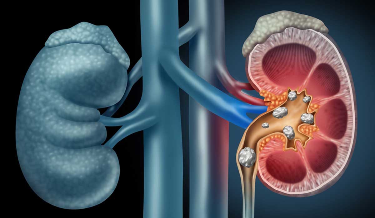 عملية حصى الكلى , كيف تتم ازالة حصوات الكلى بسهوله