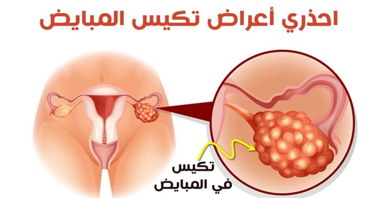 علاج التكيس على المبيض - ادوية تساعد علي حل مشكلة التكيس 2045 3