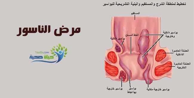 علاج الناسور بالاعشاب مجرب - الحل النهائي للتخلص من الناسور والمه 2023 2