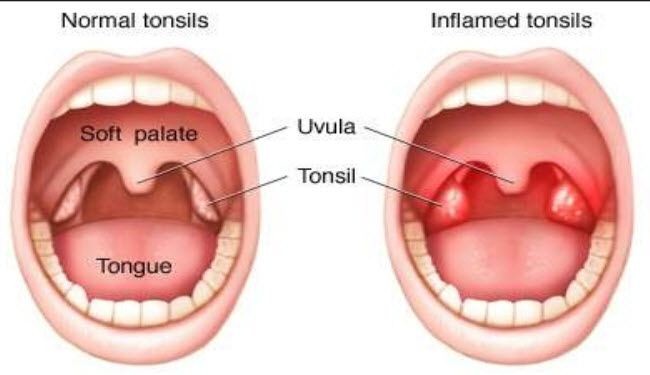 التخلص من التهاب اللوزتين , تخلص من التهاب الحلق من الان