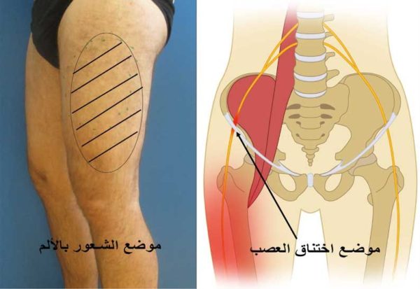 الم اعلى الفخذ - الم في الرجل ماذا افعل 2931 2