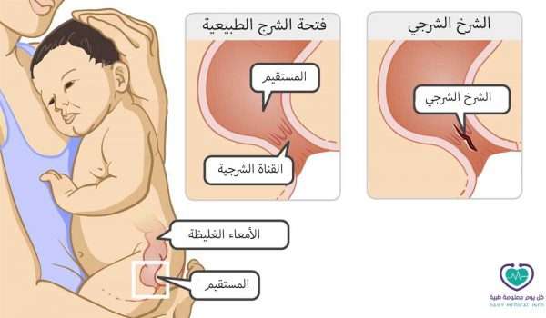 الشرج عند الاطفال , الامراض الشرجية عند الاطفال وعلاجها