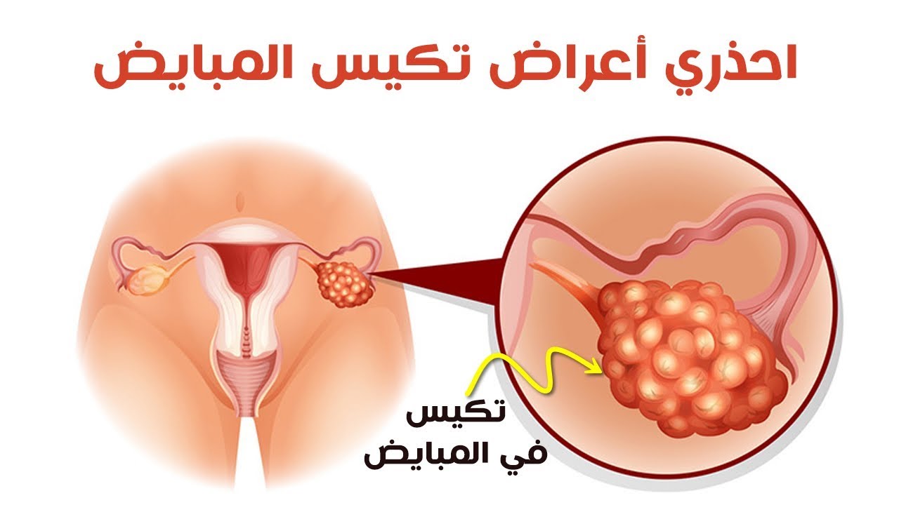 اعراض التكيس وقت الدوره - يجب الاهتمام بالصحه جيدا 2880 3