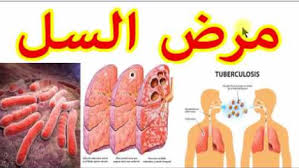 اعراض مرض الدرن , اعراض مرض السل