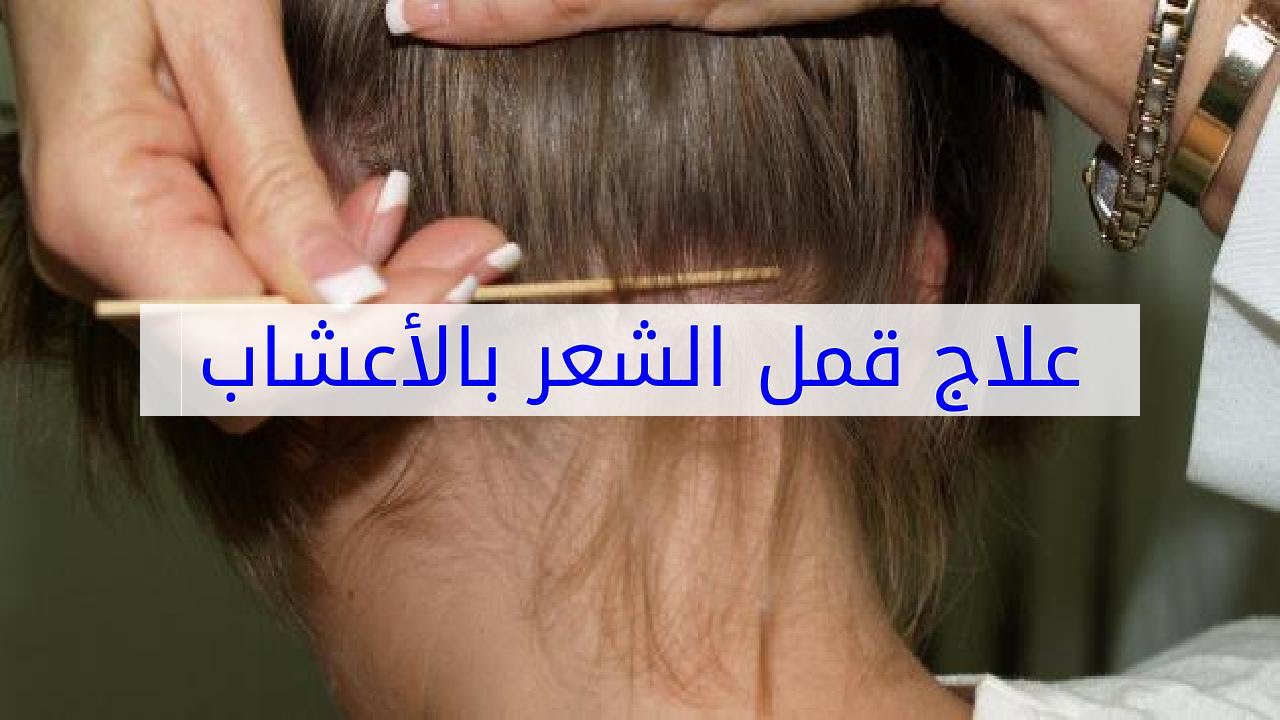 علاج القمل بالاعشاب , تخلصى منه فى غمضة عين