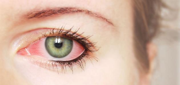 ما هو علاج احمرار العين , قل وداعا لاحمرار العين - عجيب وغريب